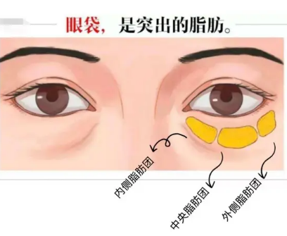 去眼袋手术