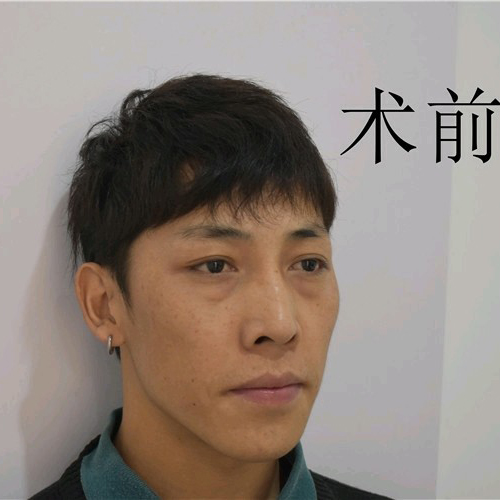 去眼袋手术
