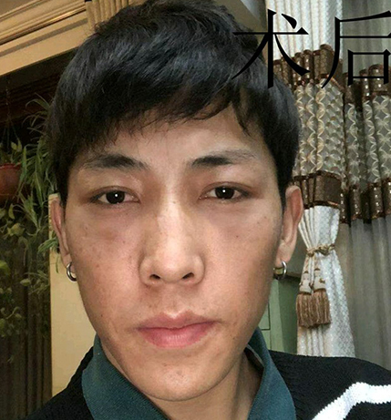 去眼袋手术