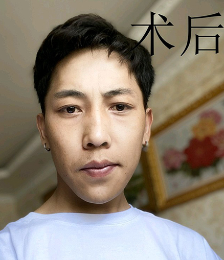 去眼袋手术