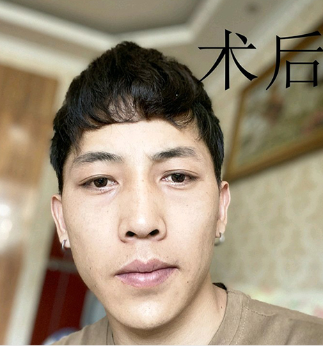 去眼袋手术