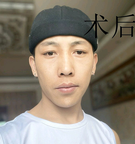 去眼袋手术