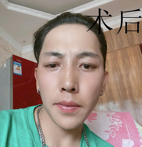 去眼袋手术