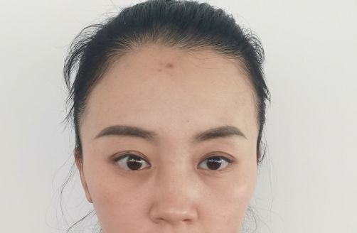去眼袋手术