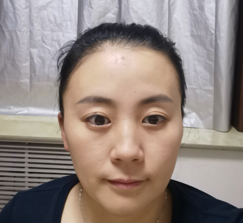 去眼袋手术