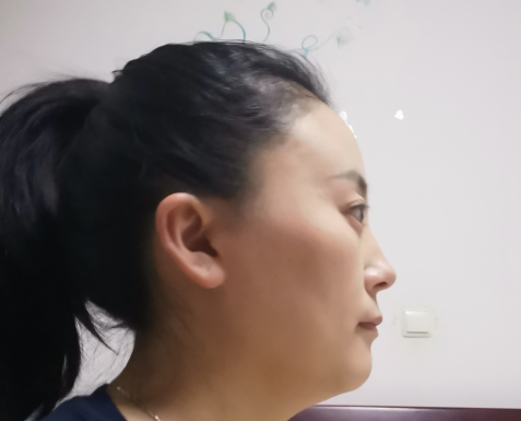 去眼袋手术