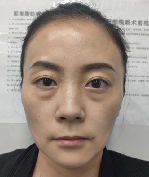 去眼袋手术