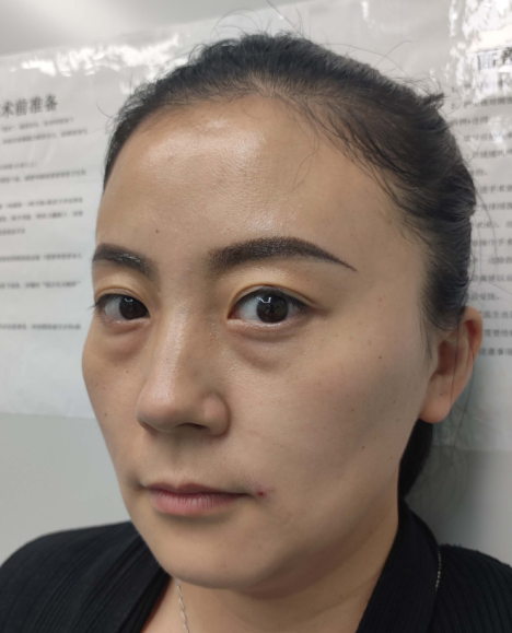 去眼袋手术