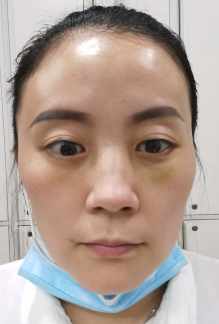 去眼袋手术