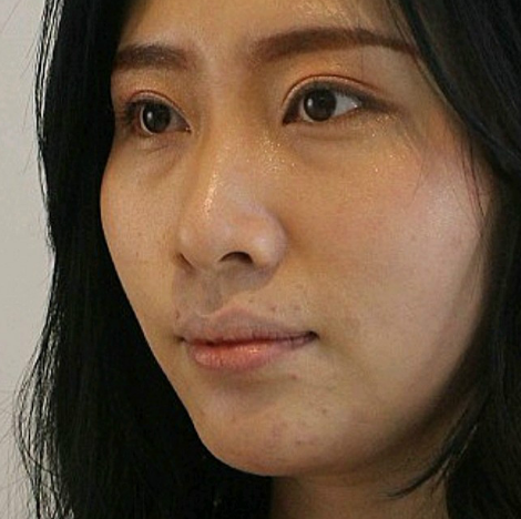去眼袋手术