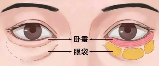 去眼袋手术