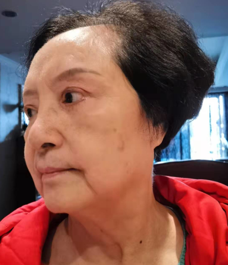 去眼袋手术