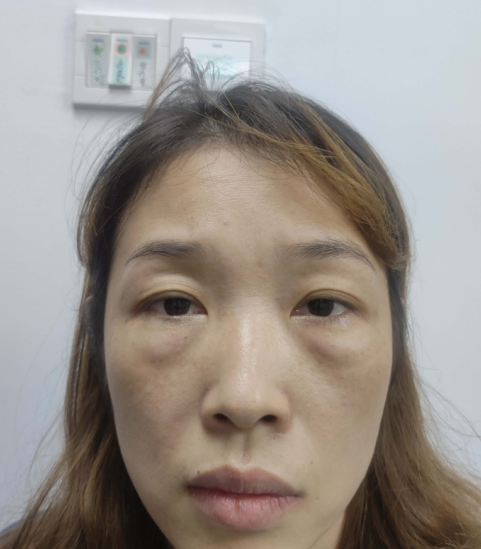 去眼袋手术