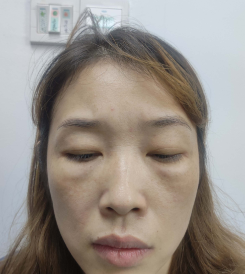 去眼袋手术