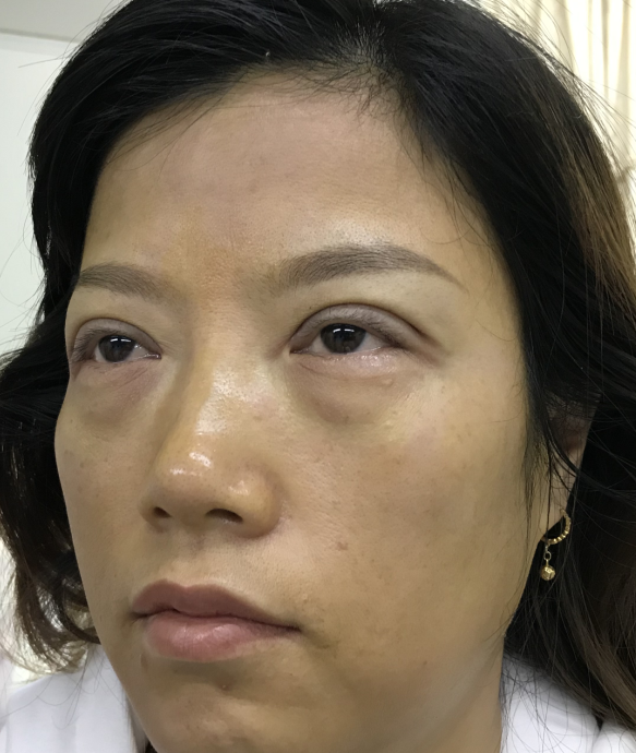 去眼袋手术
