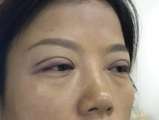 去眼袋手术