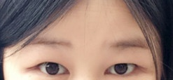 双眼皮手术