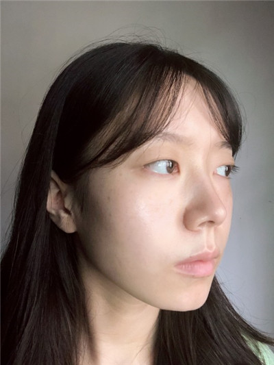 双眼皮手术
