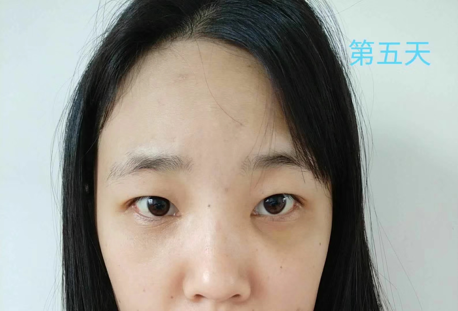 去眼袋手术