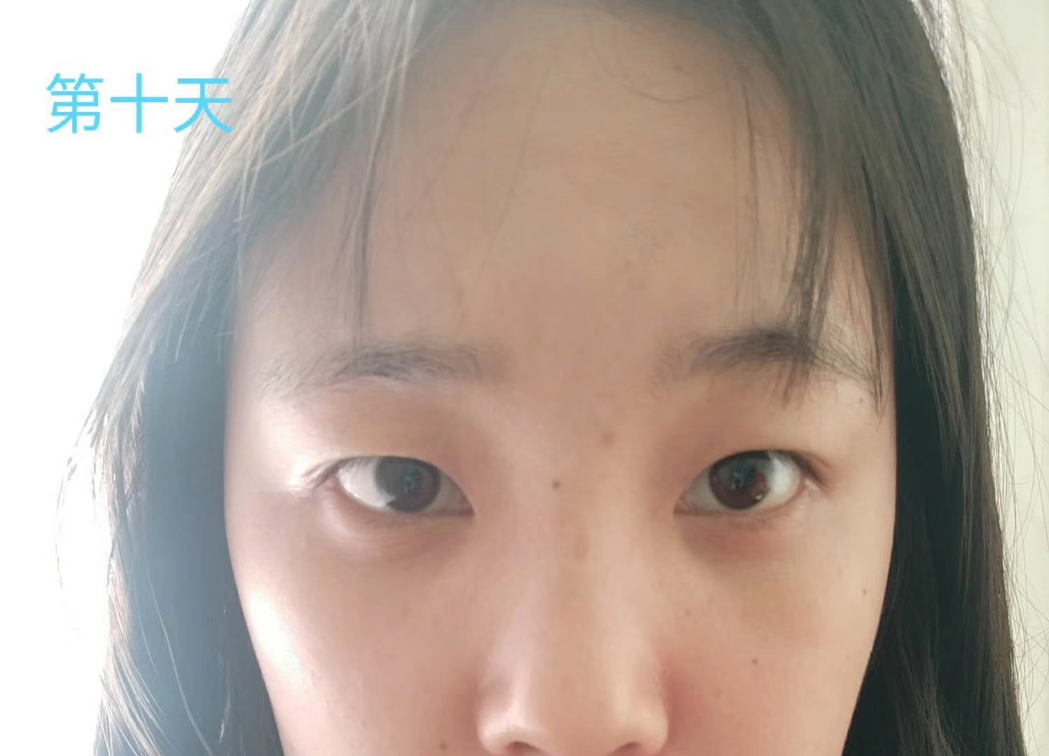 去眼袋手术