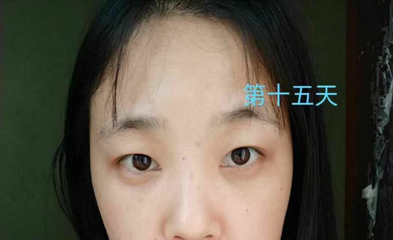 去眼袋手术