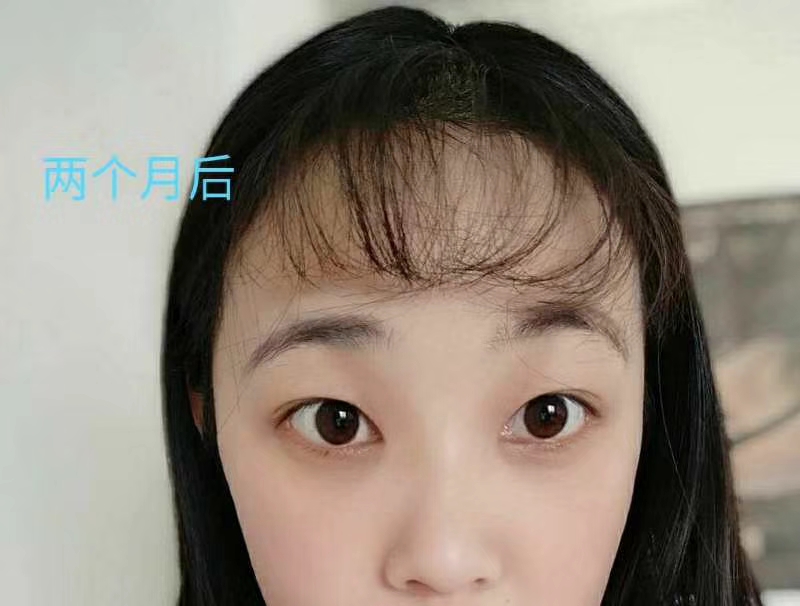 去眼袋手术