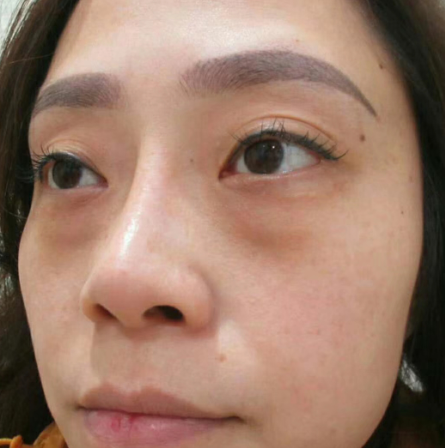 去眼袋手术