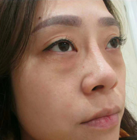 去眼袋手术