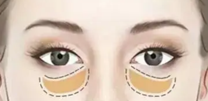 去眼袋手术