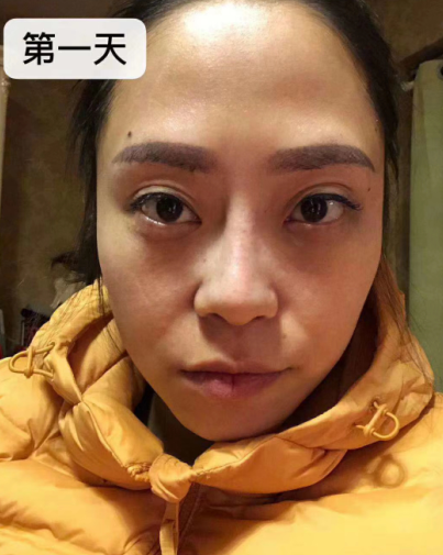 去眼袋手术