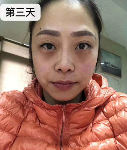 去眼袋手术