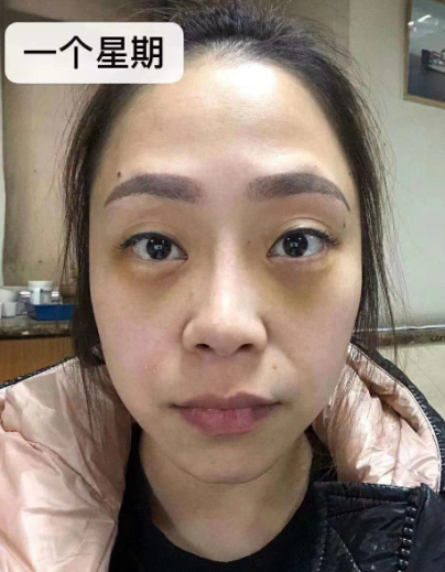 去眼袋手术