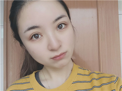 做超声波复合双眼皮7天真实分享，效果好...854