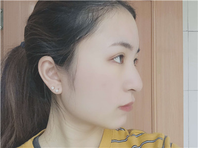 做超声波复合双眼皮7天真实分享，效果好...854