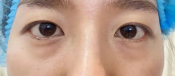 去眼袋手术