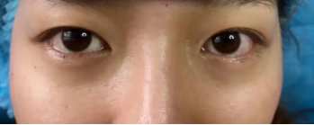 去眼袋手术