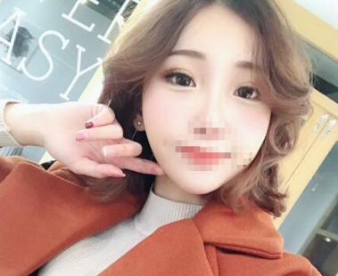 去眼袋手术