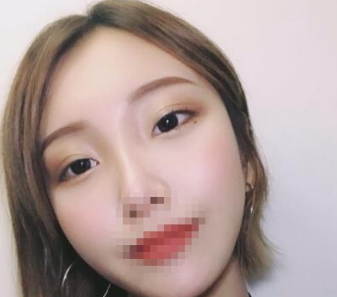去眼袋手术