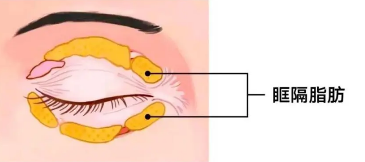 去眼袋手术
