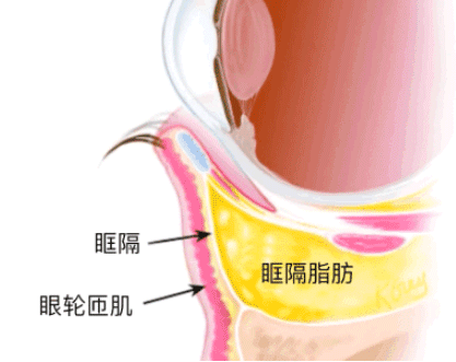 去眼袋手术
