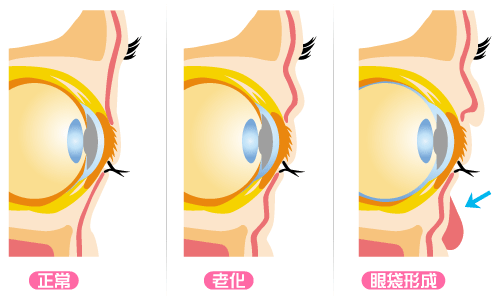 去眼袋手术