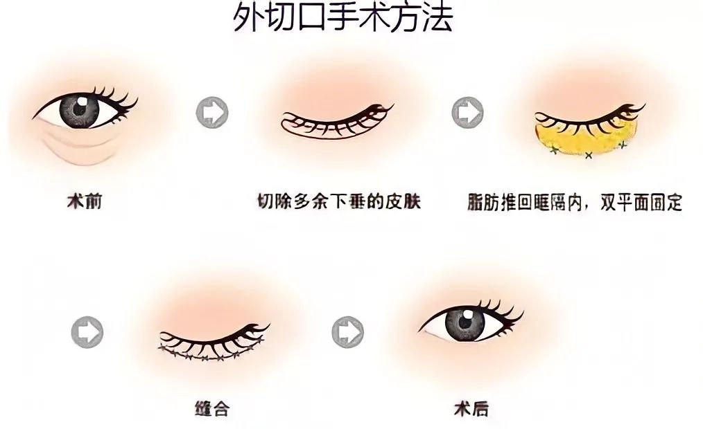 去眼袋手术