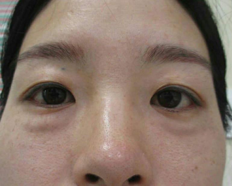 去眼袋手术