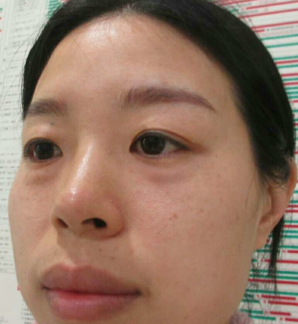 去眼袋手术