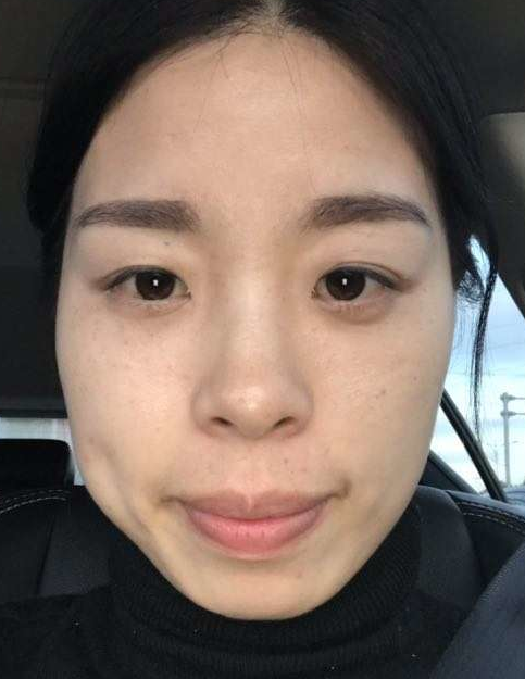 去眼袋手术