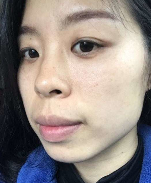 去眼袋手术