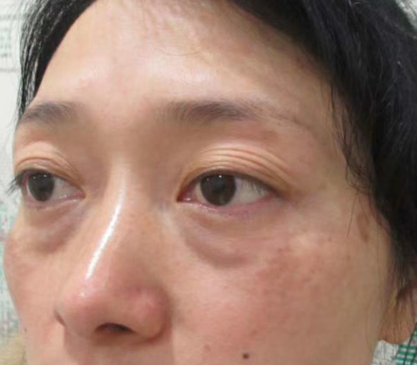 去眼袋手术