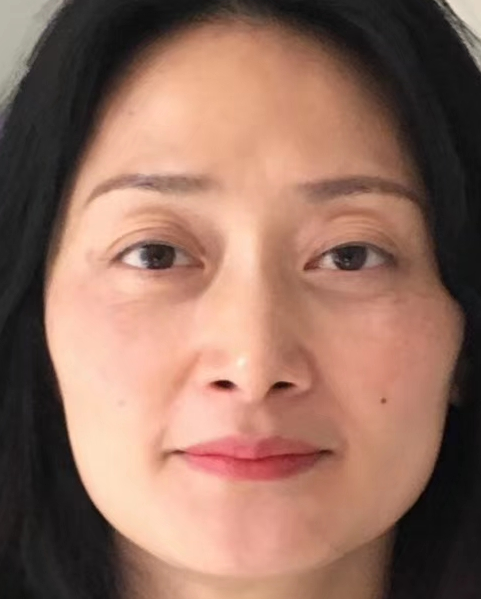 去眼袋手术