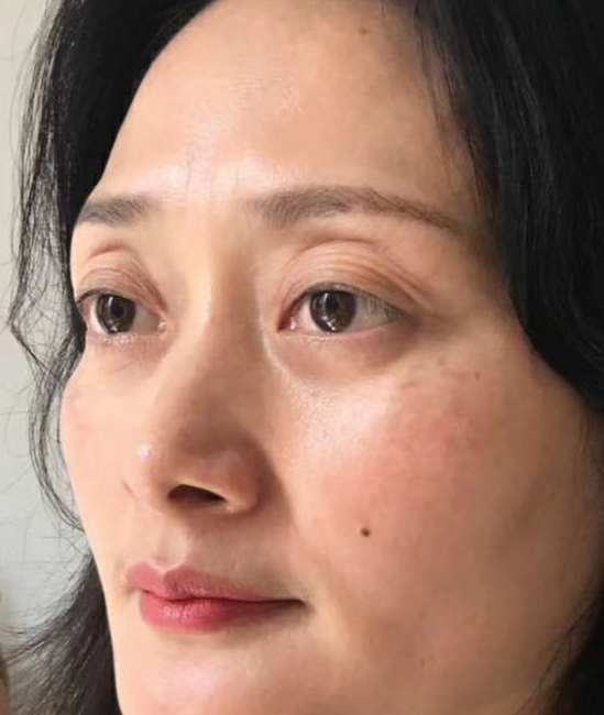 去眼袋手术