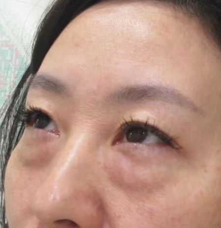 去眼袋手术